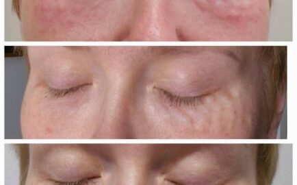 Rejuran eye treatment consultation at MD Cosmetic Nurse in Sydney