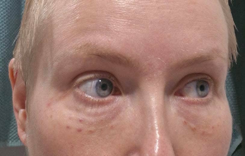 Rejuran under eye treatment at MD Cosmetic Nurse in Sydney