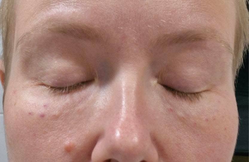 Rejuran eye treatment dots at MD Cosmetic Nurse in Sydney