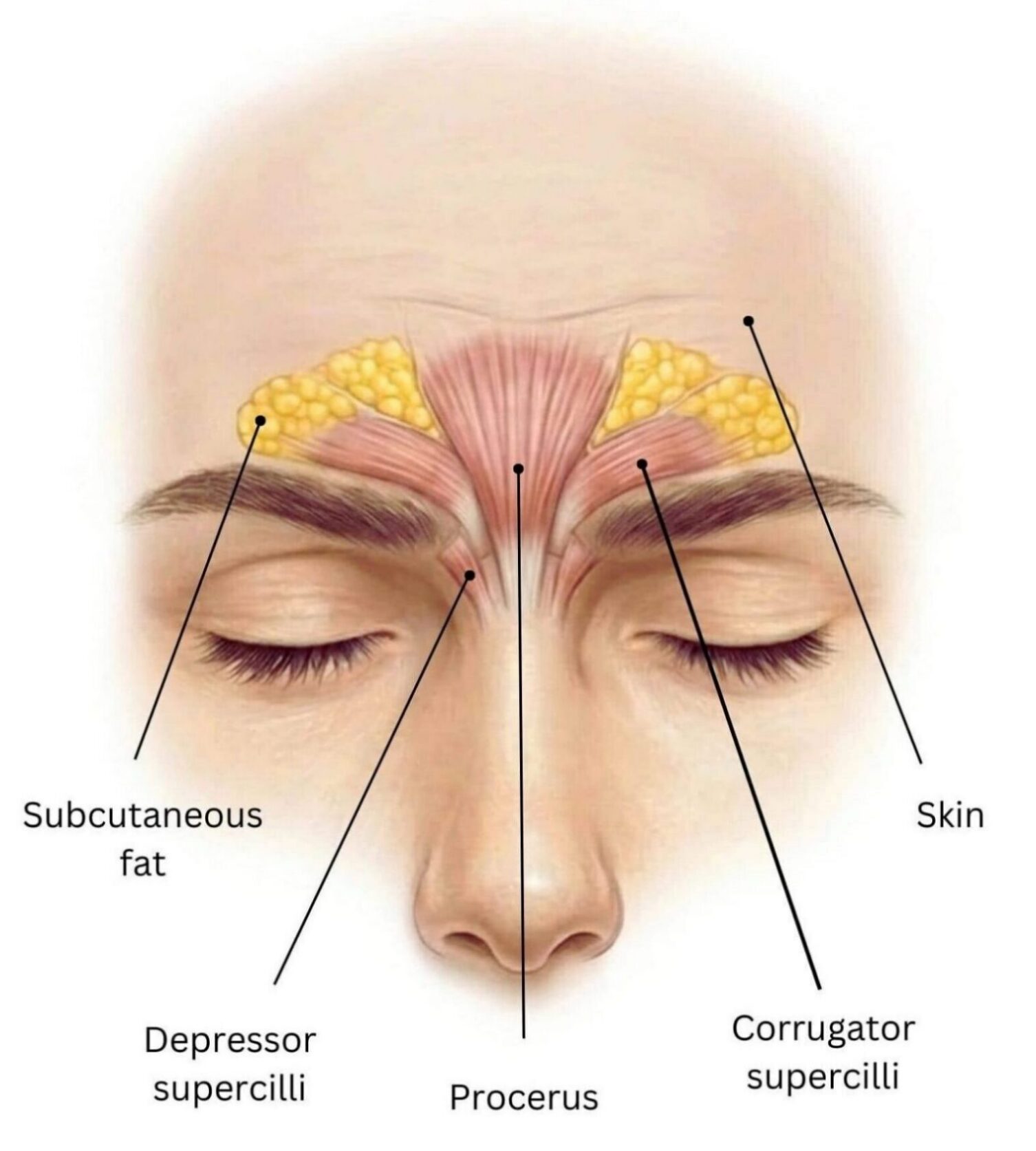 Anatomy diagram showing the corrugator supercilli and procerus muscles responsible for glabellar lines between the eyebrows.